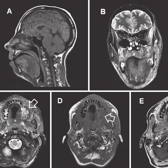 MRI Face With Contrast